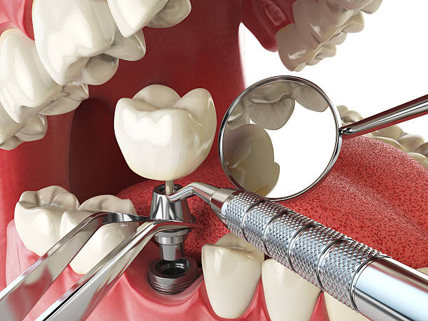 Emergency Dental Filling Replacement in VA